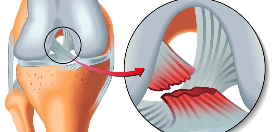 A lábak ízületeinek osteoarthritis kezelése